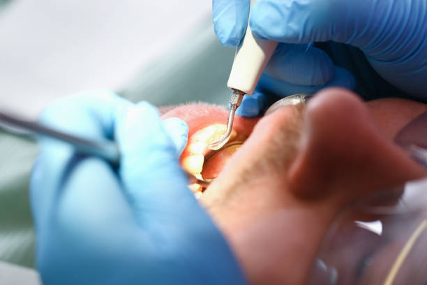 Best Emergency Root Canal Treatment in Madison, NC