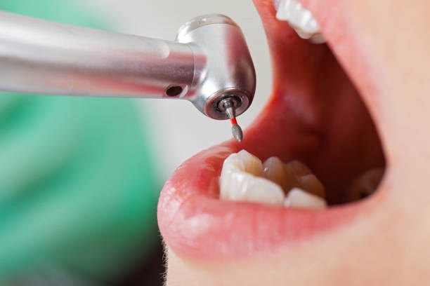 Best Emergency Tooth Extraction in Madison, NC